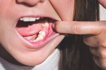 Tooth Extraction